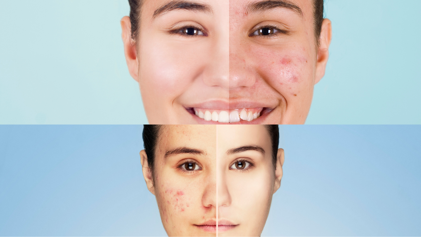 Moringa Neem Calendula Chamomile Salve/Balm. Relief for Eczema, dry skin and Psoriasis (pack of 2).